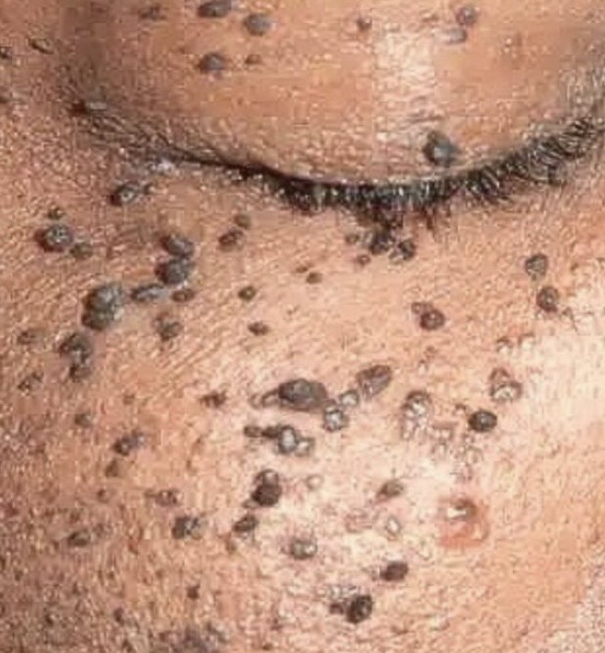 Skin Tag Consultation at The Art of Glow by Chelle in New York, NY