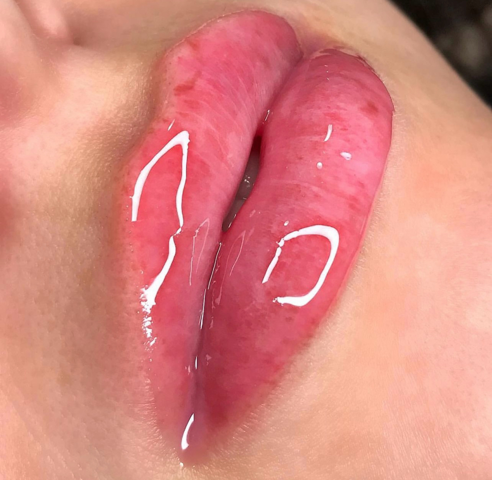 Hydra lips (glow lips)