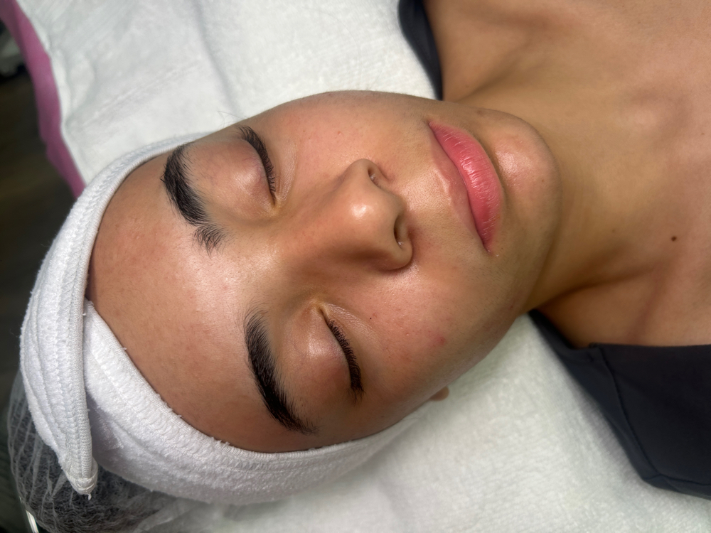 Acne Facial