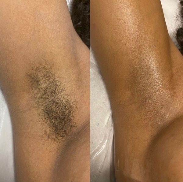 Under Arm at Esoteric Esthetics in Pecos, TX