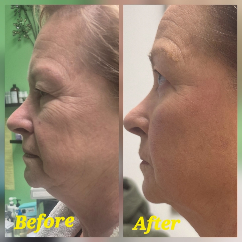 3 Sessio👁️ Eye Lift & Glow Facial at JUST BEAUTIFUL SKIN in Goose Creek, SC