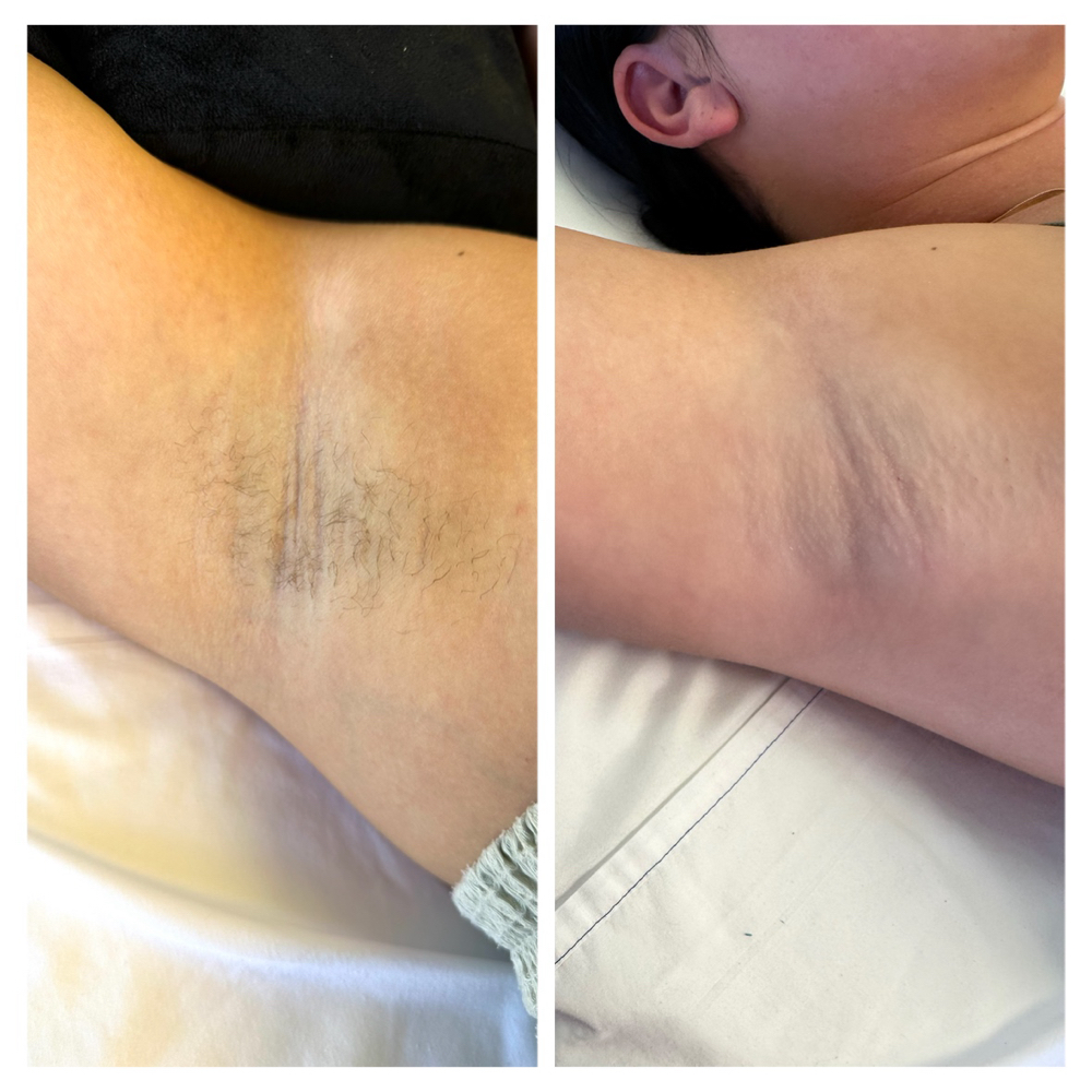 Underarm Waxing