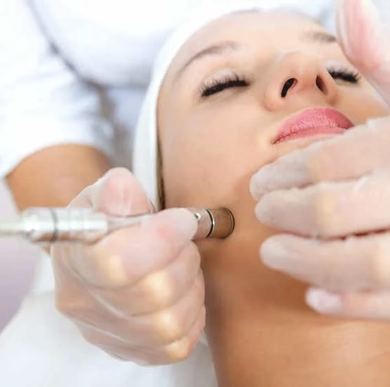 Microdermabrasion