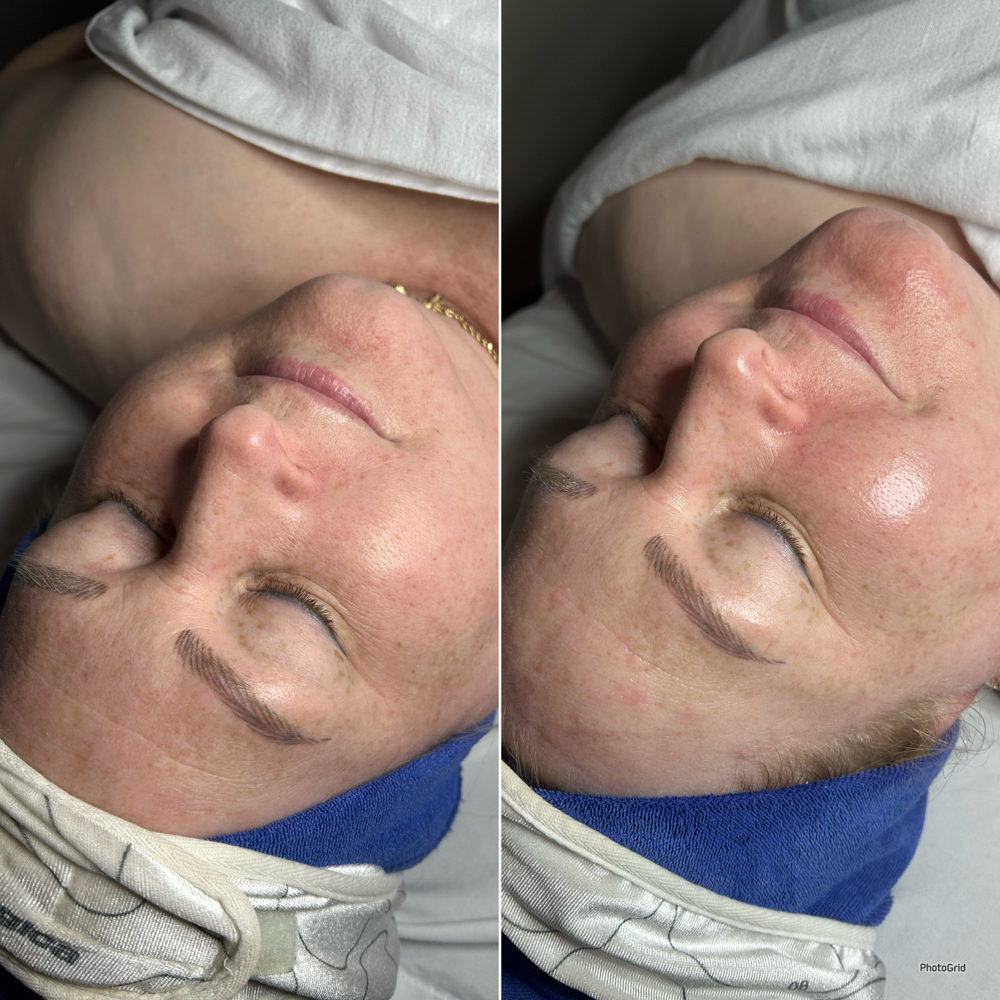 The Chemical Peel at Golden Moon Esthetics, LLC in Frisco, TX
