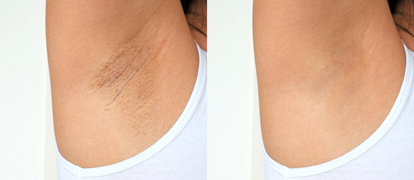 Underarm Treatment