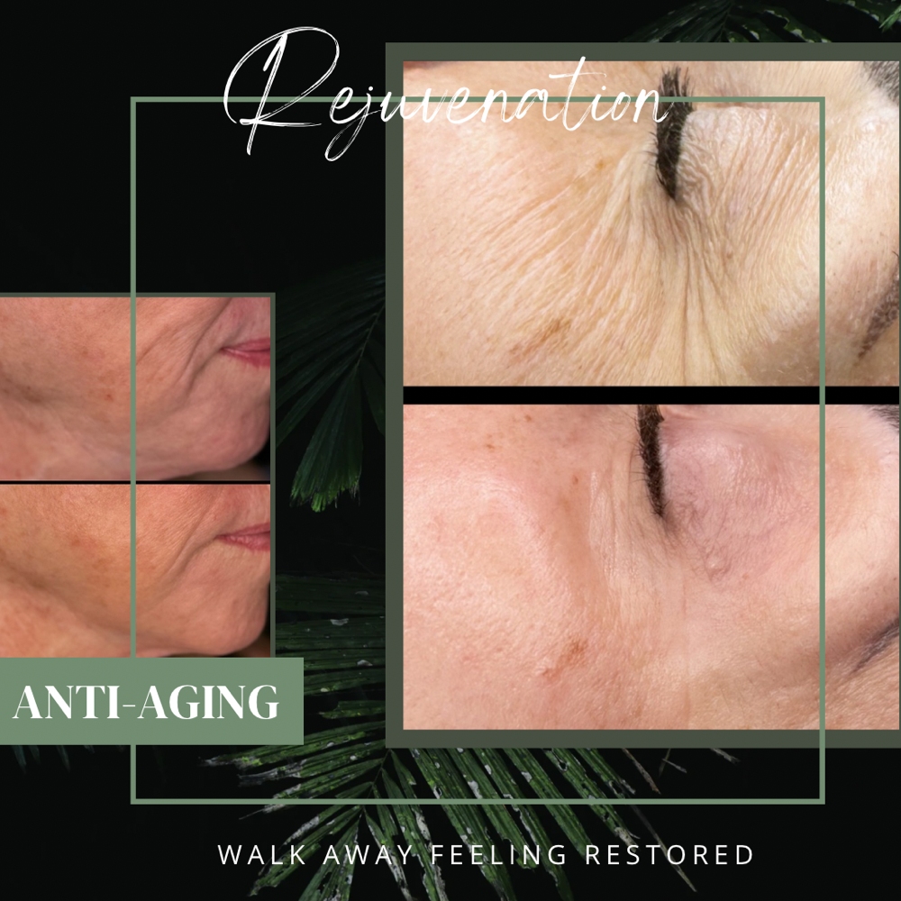 Rejuventation (Anti-Aging)