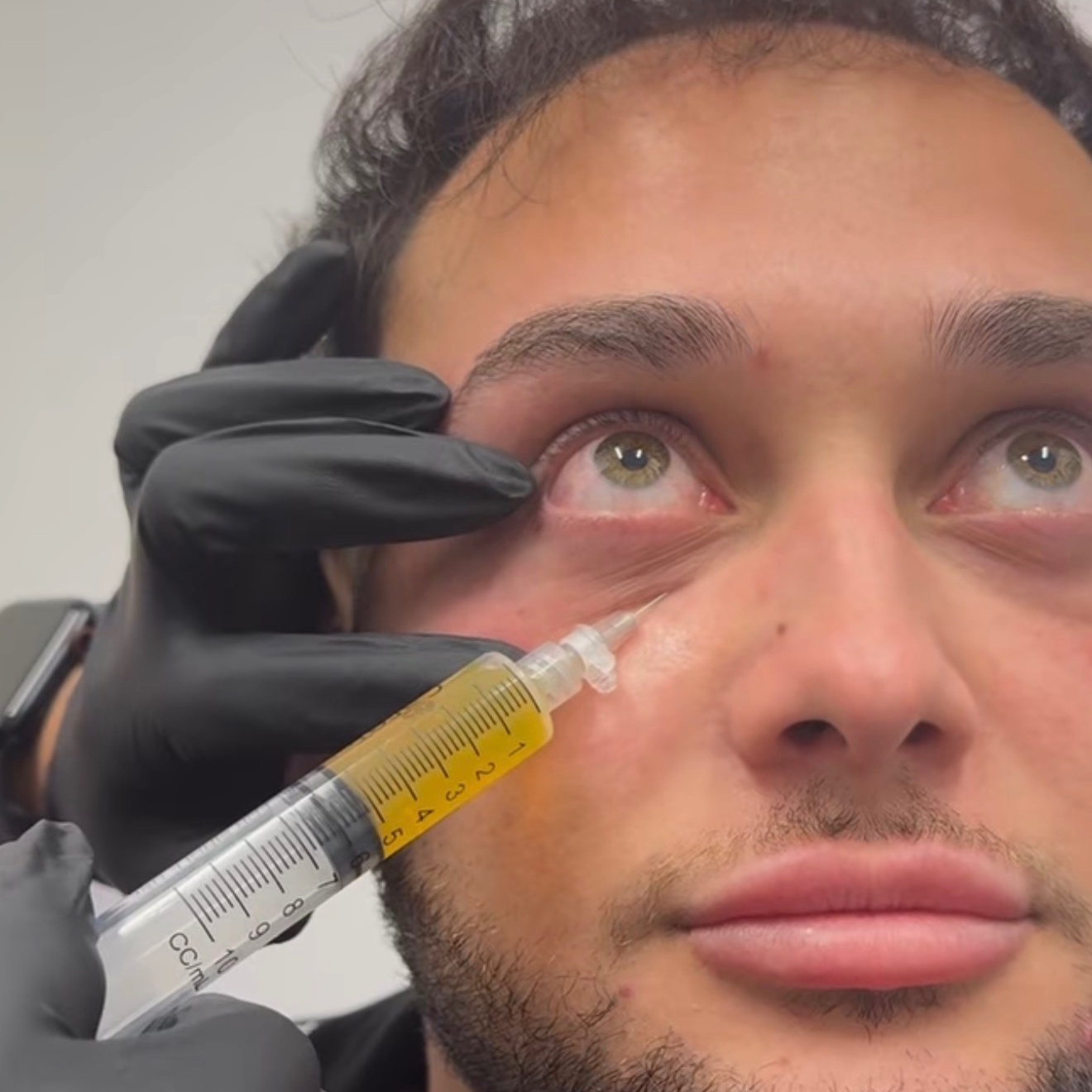 PRP Undereye Rejuvenation at Pleasures of Beautee in Atlanta, GA