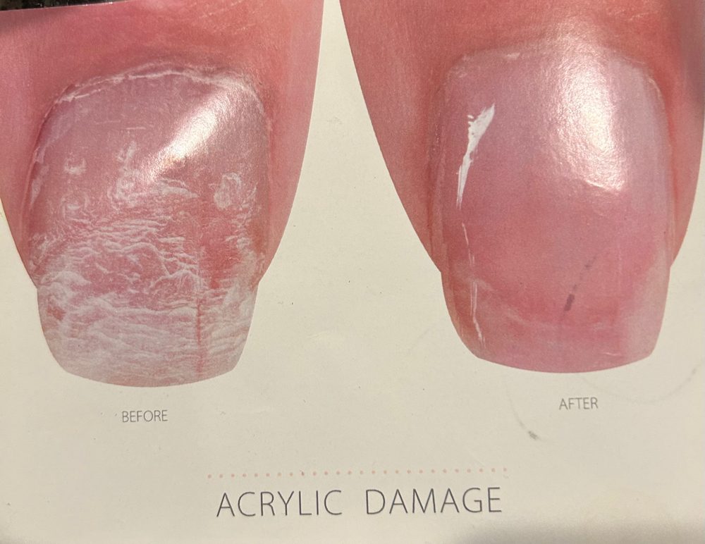 Nail Treatment