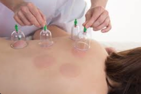 Cupping