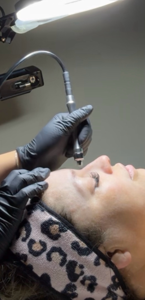 Diamond Microdermabrasion