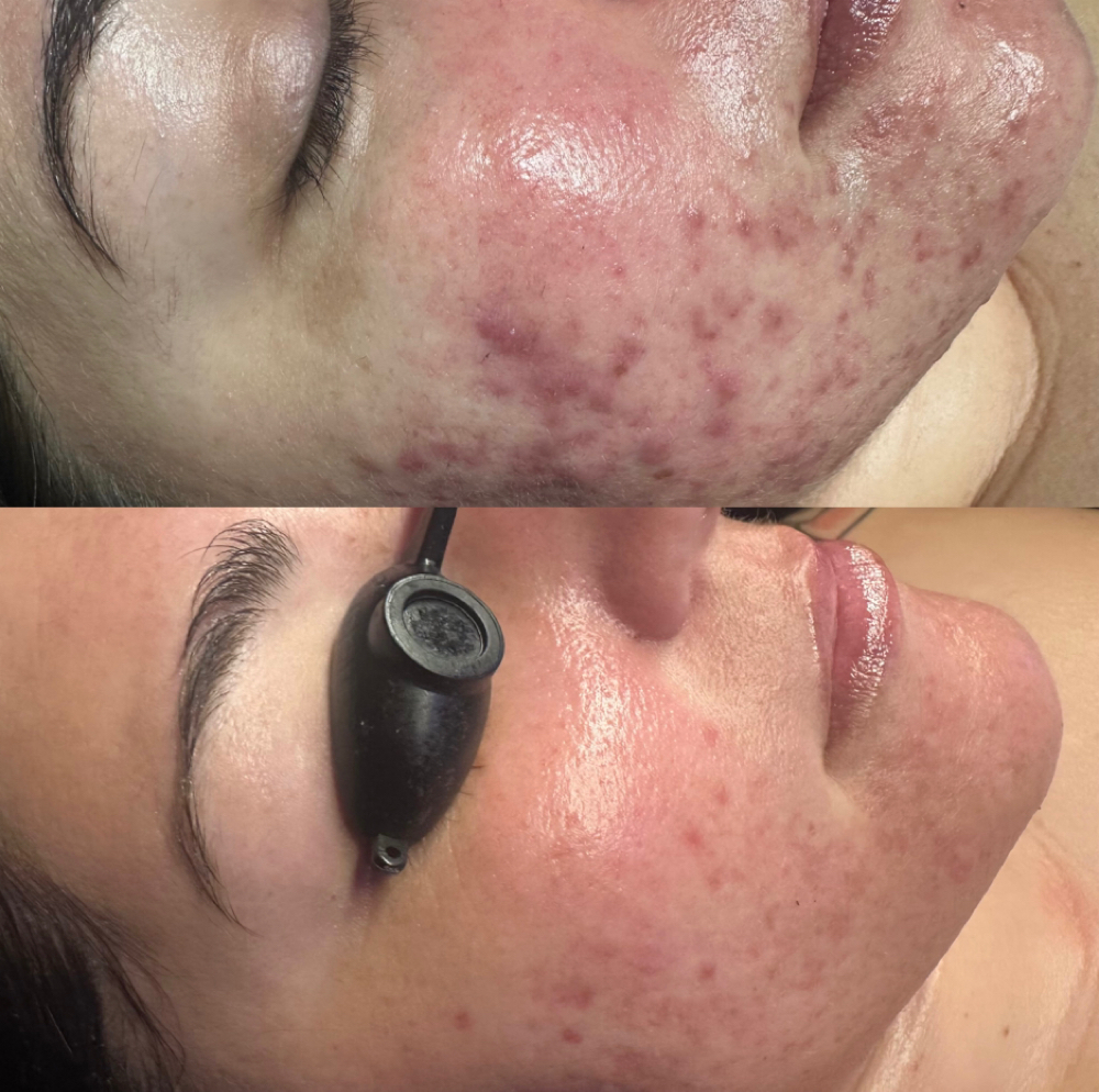 Potion Of Purity (Acne) at Conjured Beauty in Cypress, CA