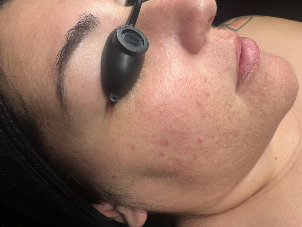 Potion Of Purity (Acne)