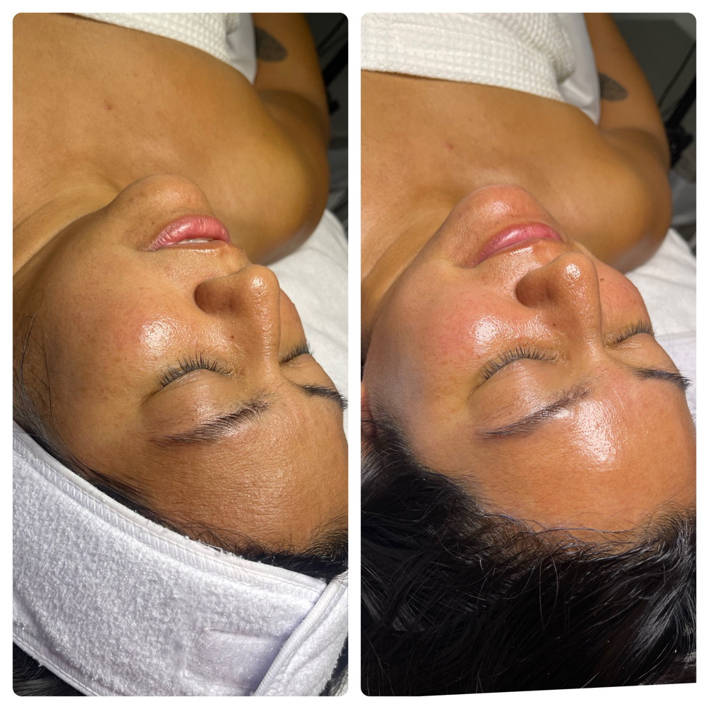 6 BioRePeel w/microneedling Package