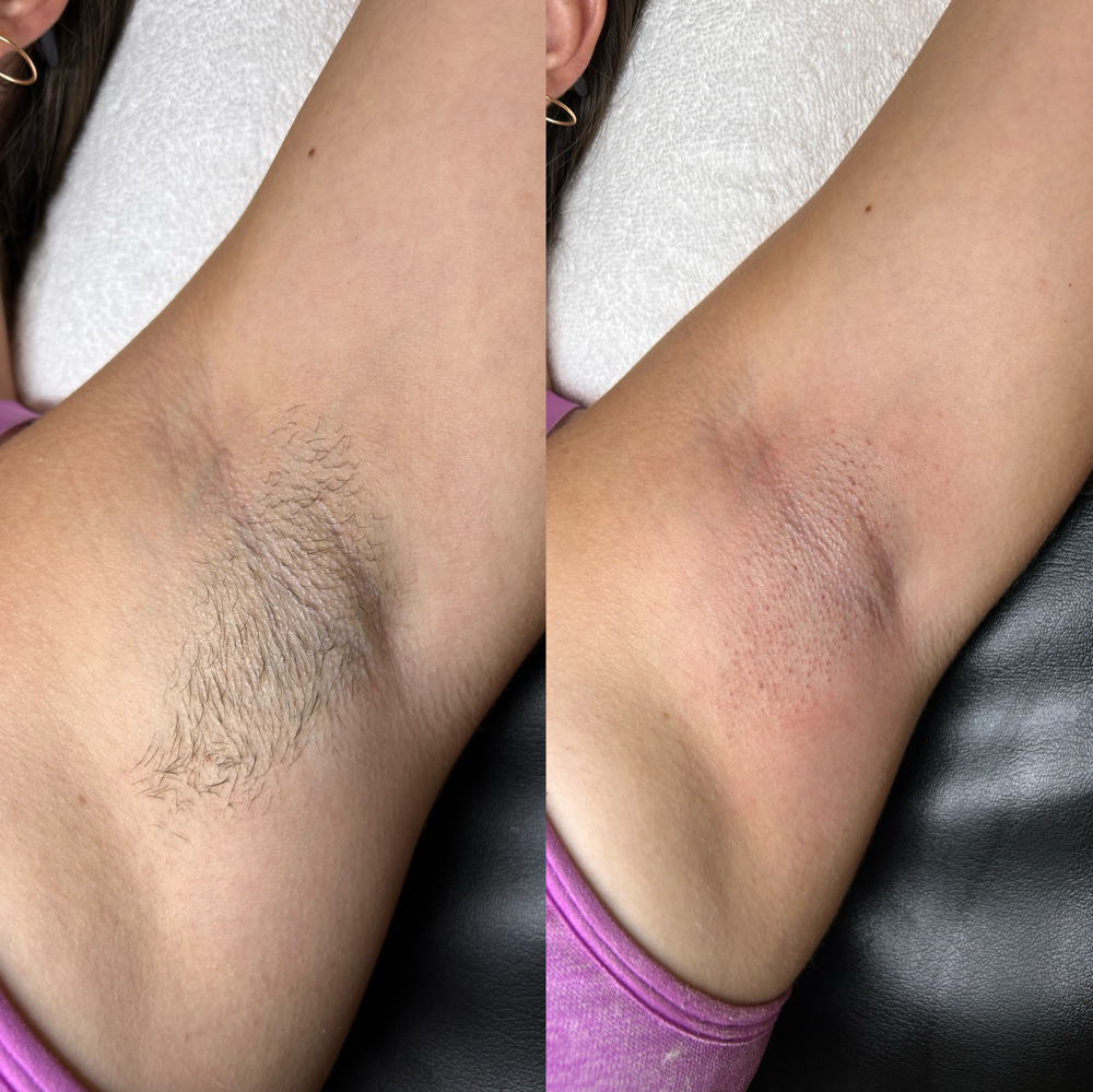 Underarms