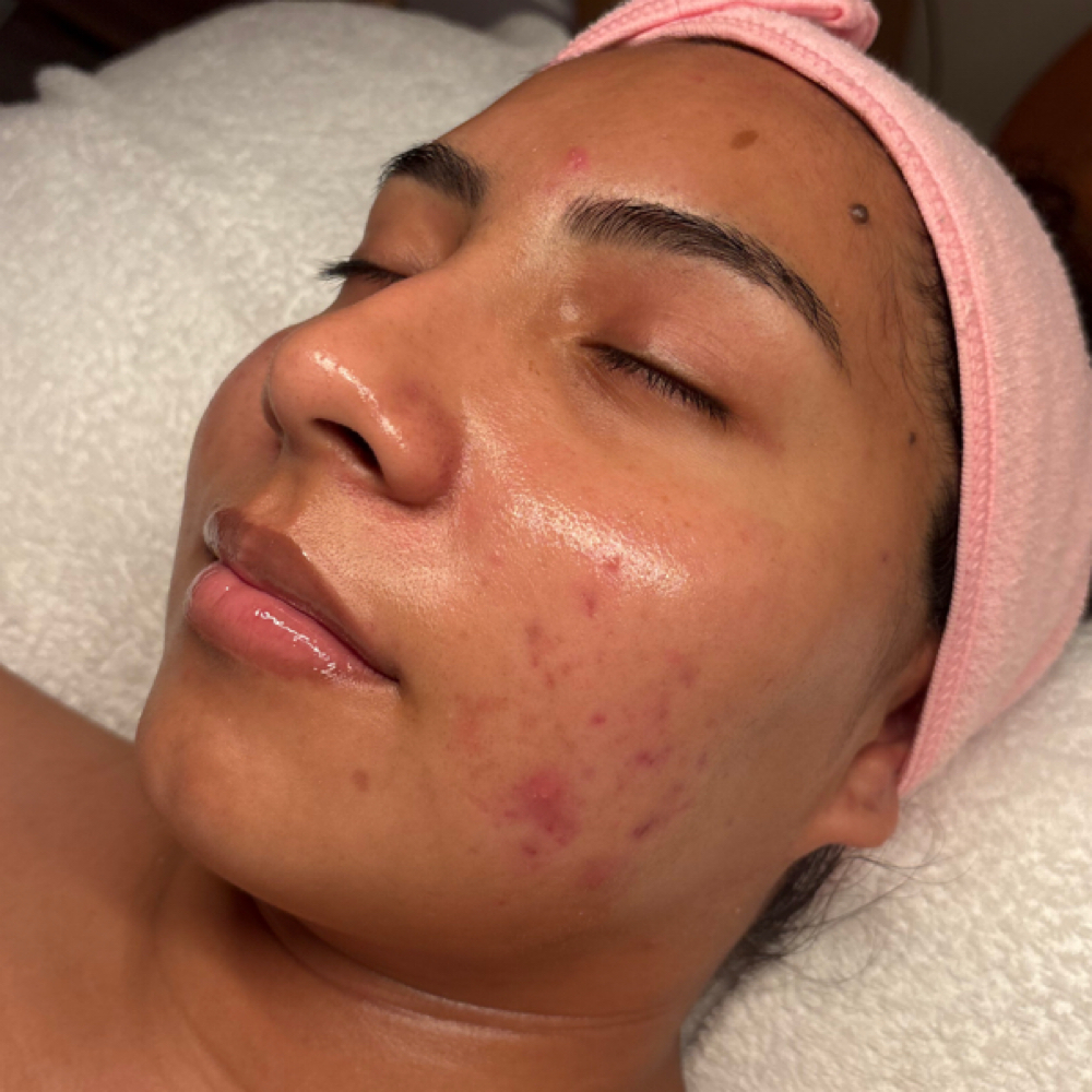 Acne Detox Facial at KH Esthetics in Texarkana, TX