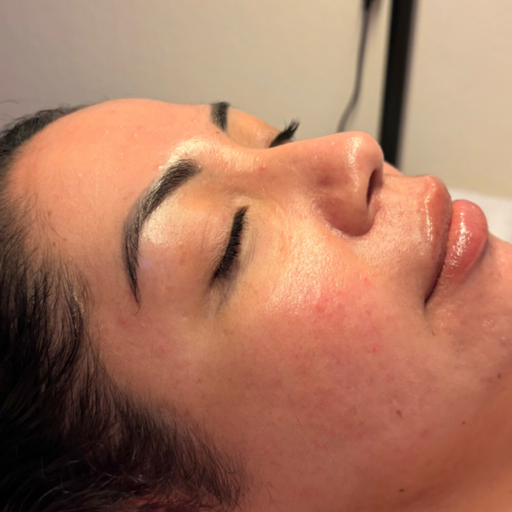 Acne Detox Facial at KH Esthetics in Texarkana, TX