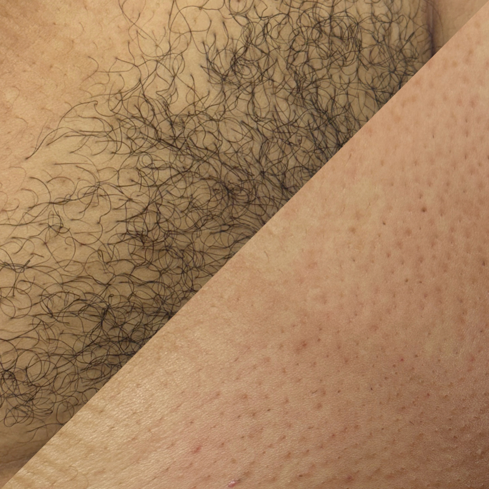 Brazilian Wax at The SKN Studio in Greenville, NC