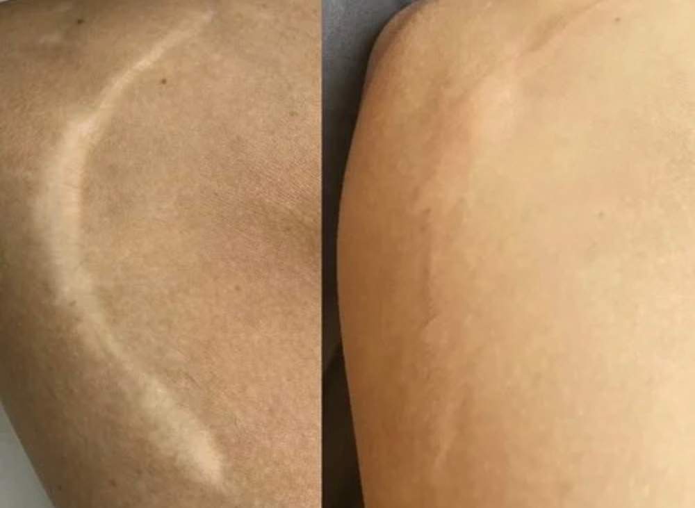 Camoflauge Scar Treatment