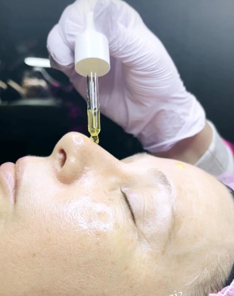 Melasma Treatment