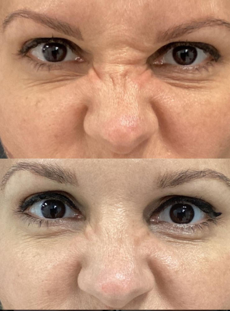 Bunny Lines Botox/ Arrugas De Nariz at Revital Med Aesthetics & Wellness in Oceanside, NY
