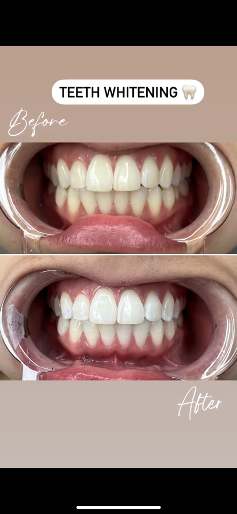 Teeth Whitening 🦷
