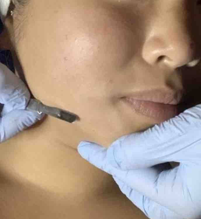 Dermaplaning Facial