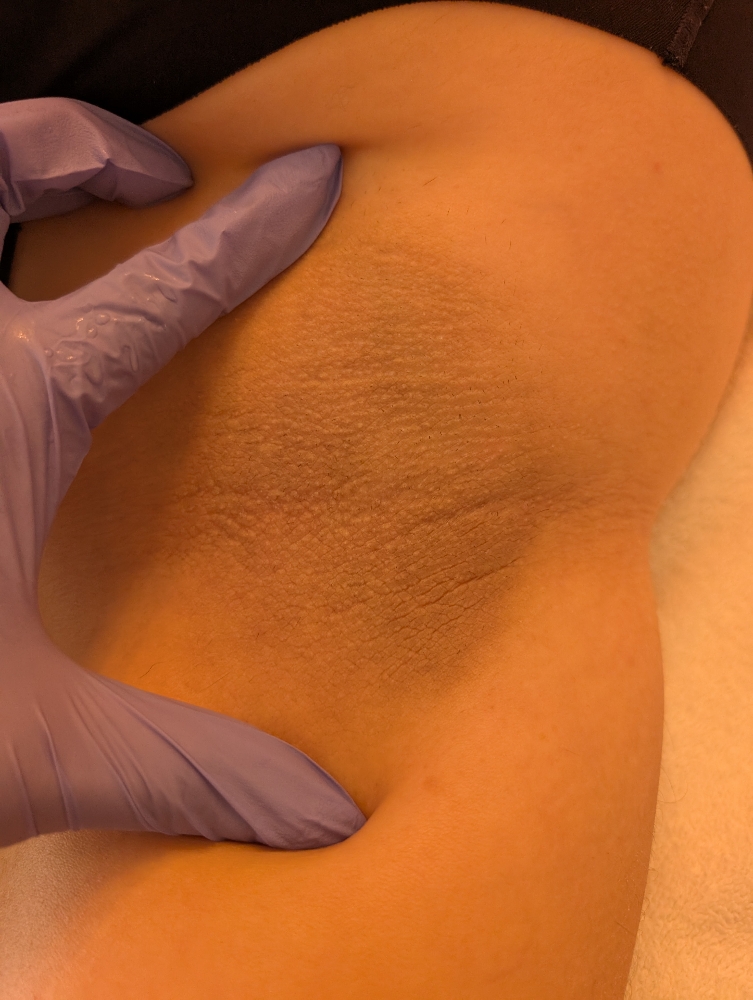 Body Peel