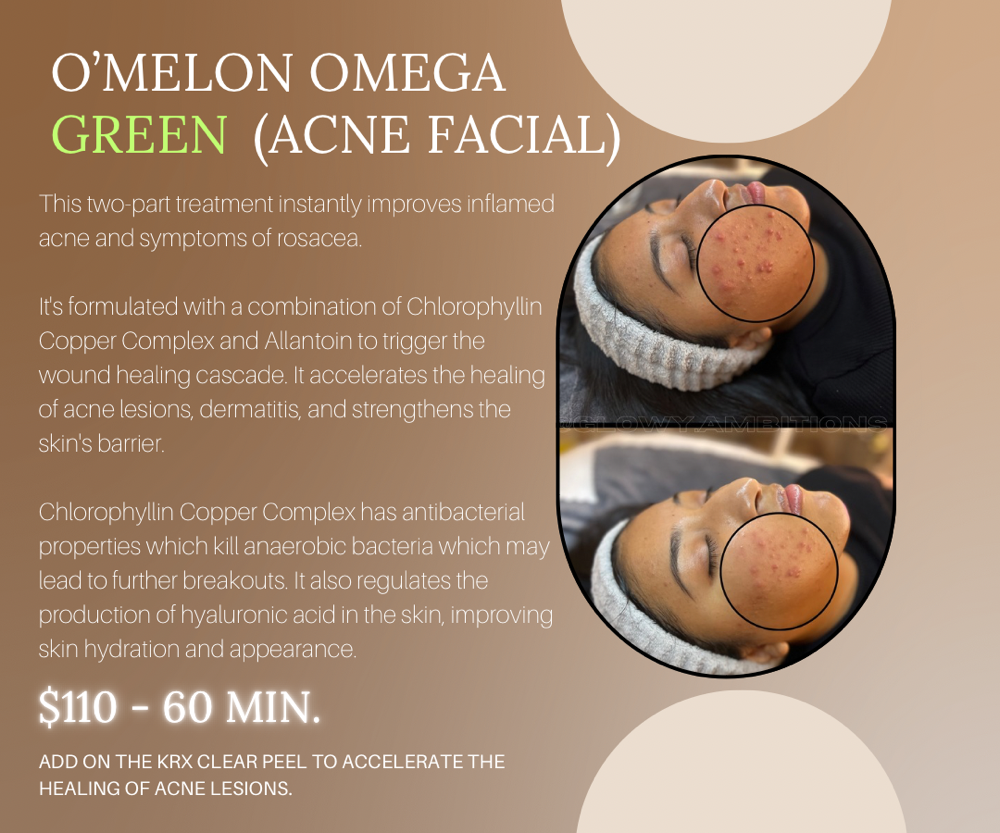 Acne Facial