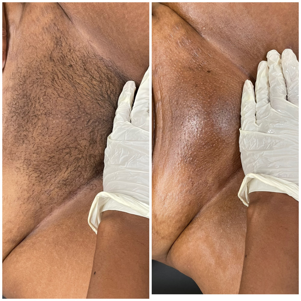 Brazilian Wax