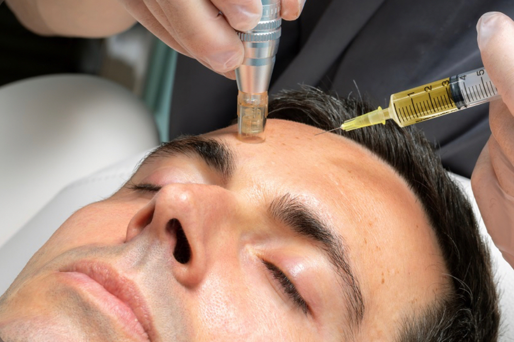 Microneedling