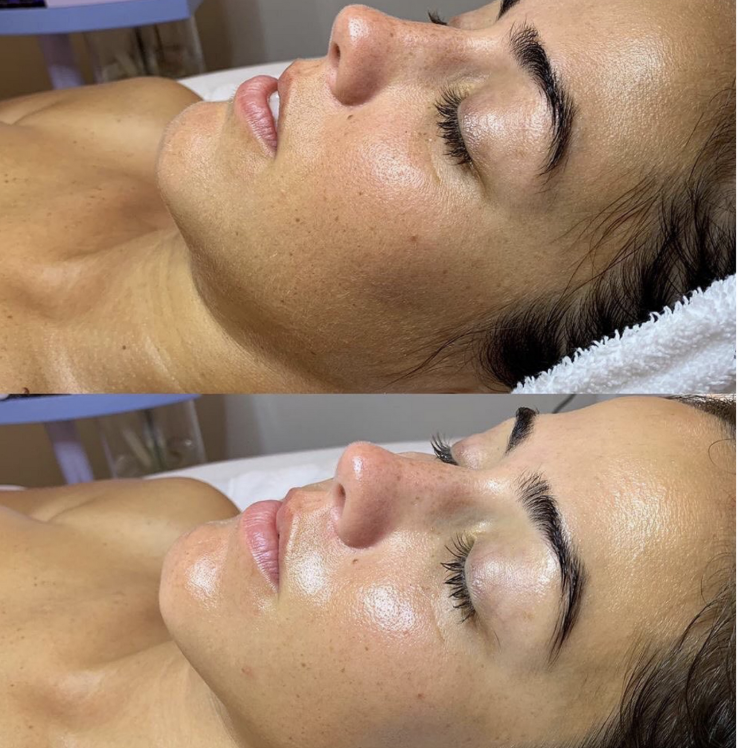 Oxygen Facial