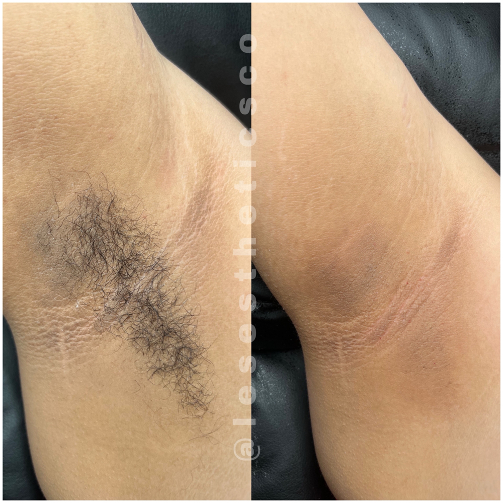 Underarm Wax