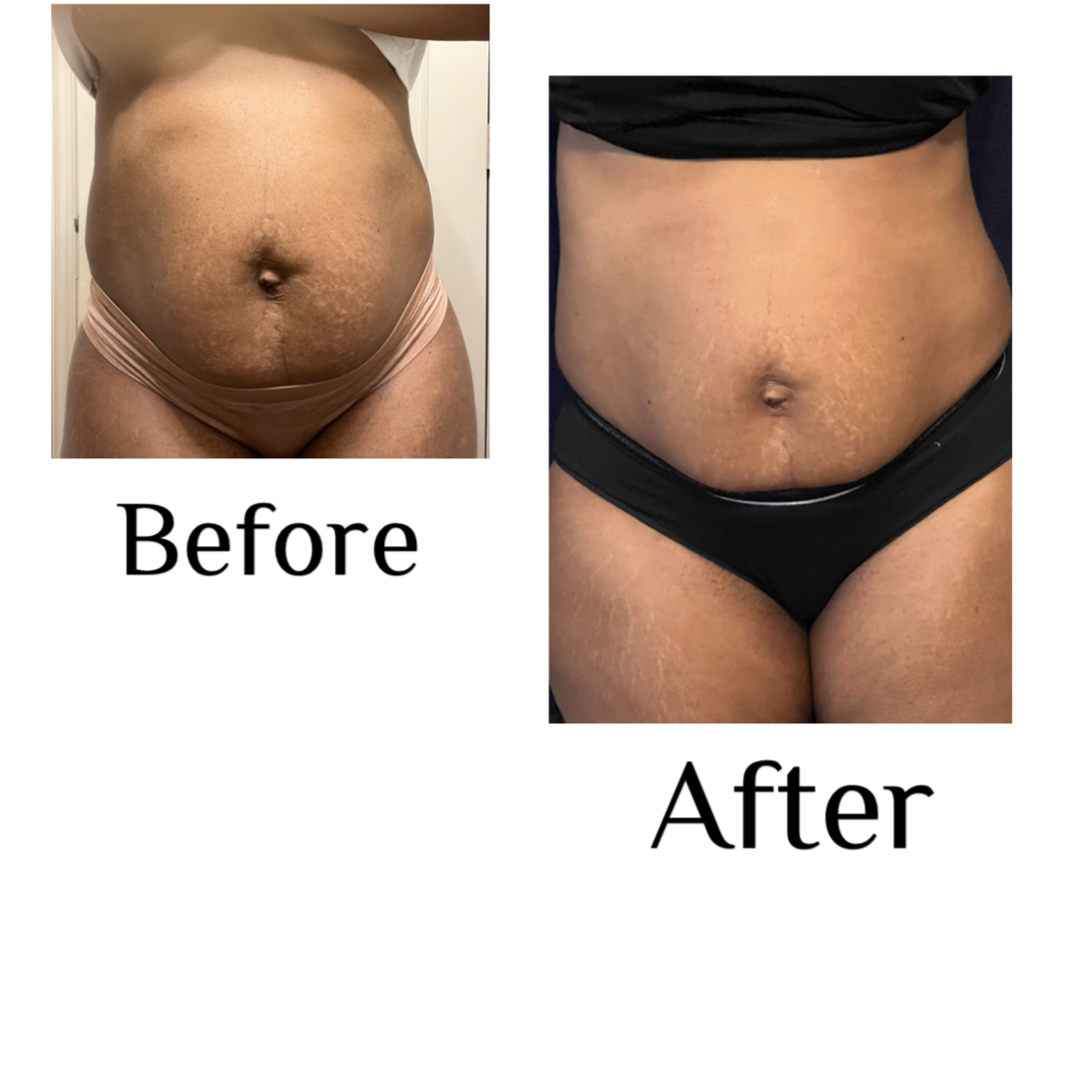 Non-Invasive Laser Lipo