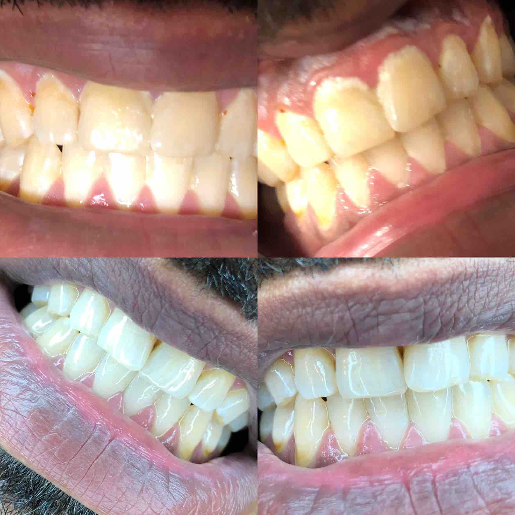 Express Whitening