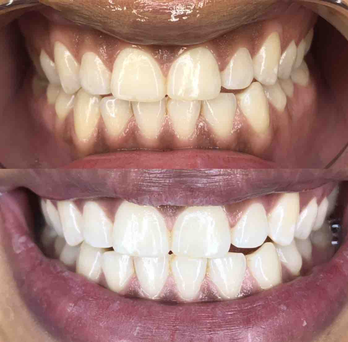 Diamond Whitening