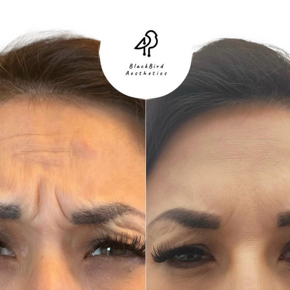 Neurotoxin Treatment at BlackBird Aesthetics in Fort Worth, TX