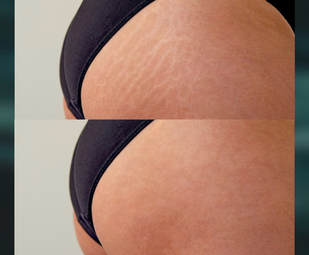 Inkless Stretch Mark/ Scar Camo