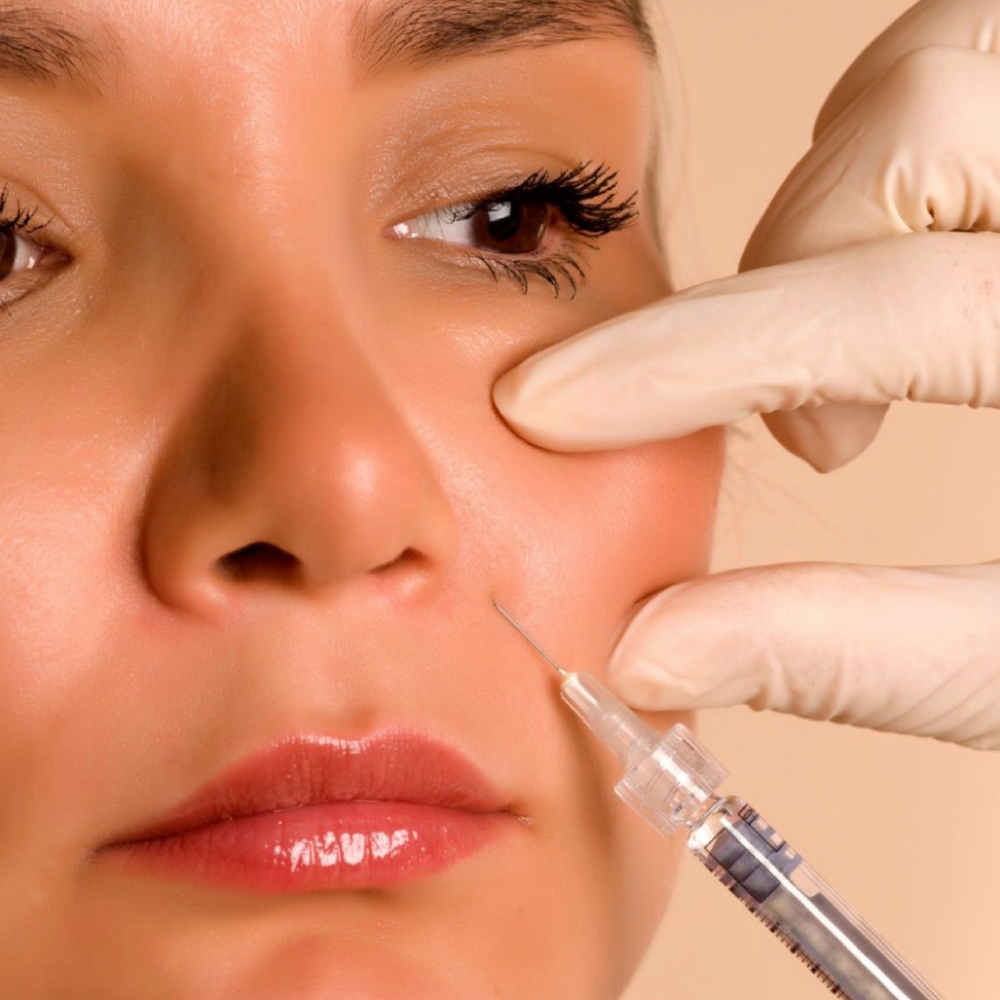 NASOLABIAL FOLD FILLER