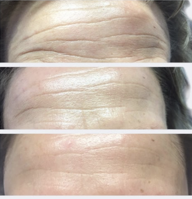 MYO-FIX BioFacial at AV Esthetique in Highland Park, IL
