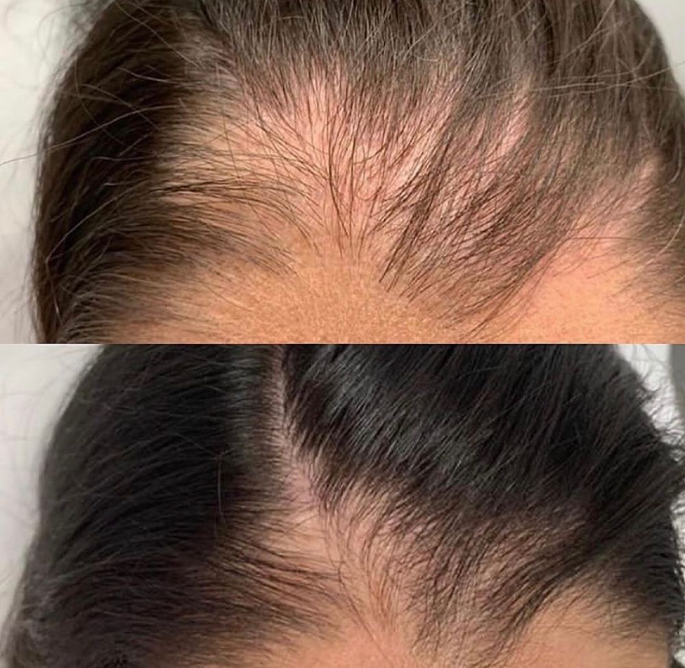 PRF HAIR TREATMENT