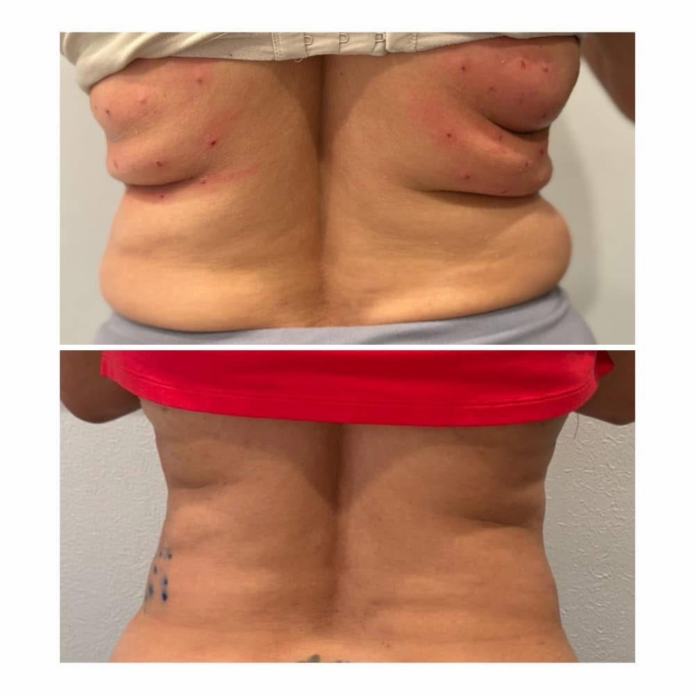 Lipo Dissolve at Monroe’s Everlasting Beauty in Corpus Christi, TX
