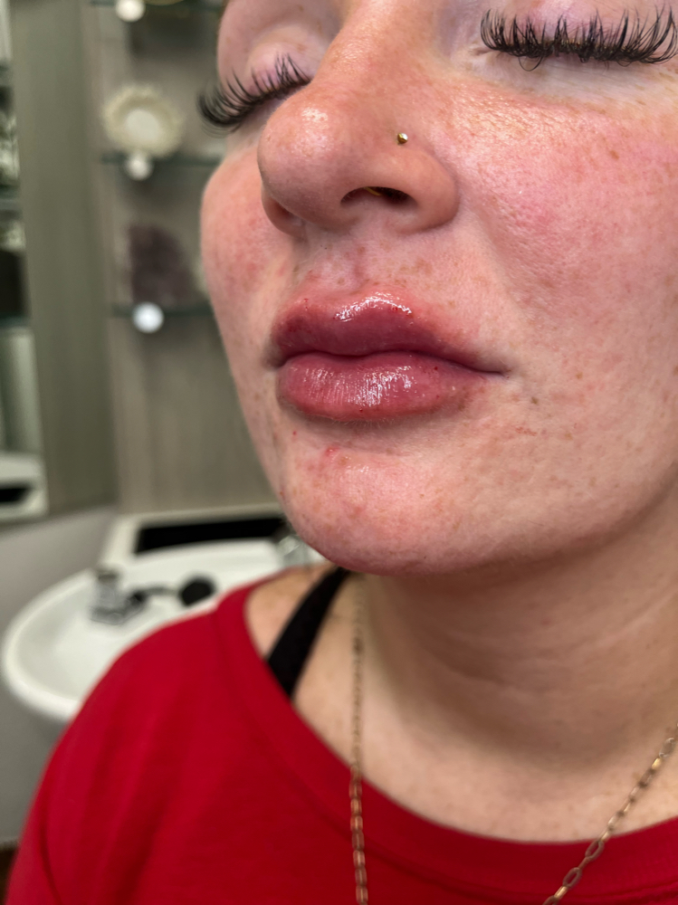 Needle-less Lip Filler 2ML