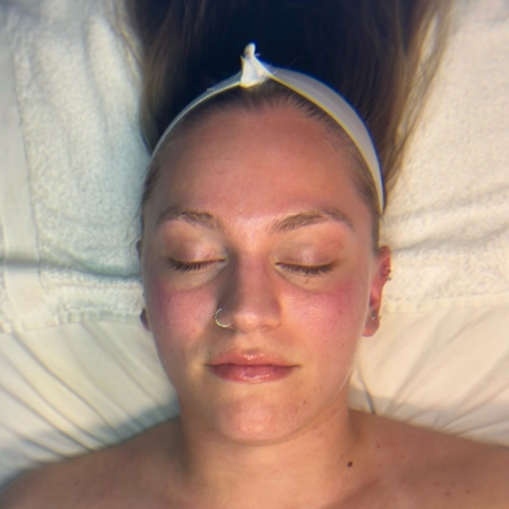 Zero Downtime Peel at It is Wellness Holistic Health in Stratford, CT