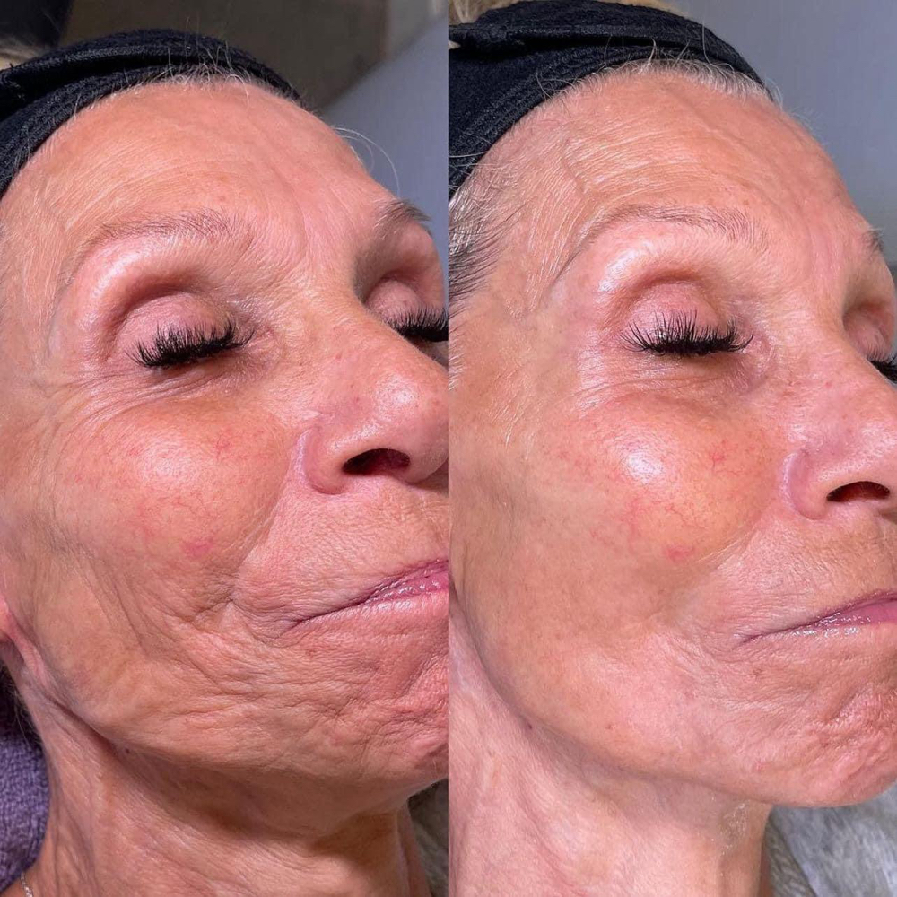 Anti-Aging Facial