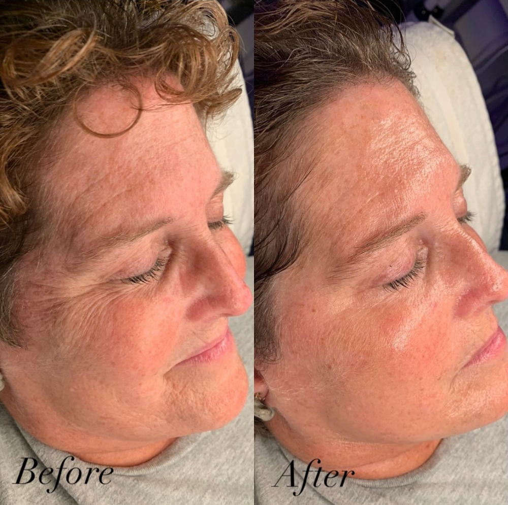 Lift and Sculpt Facial