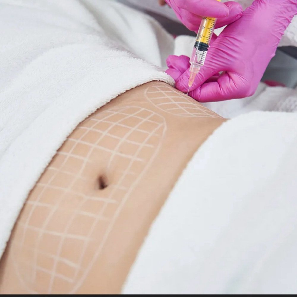 lipolytic mesotherapy at BelleBee in Hereford, TX