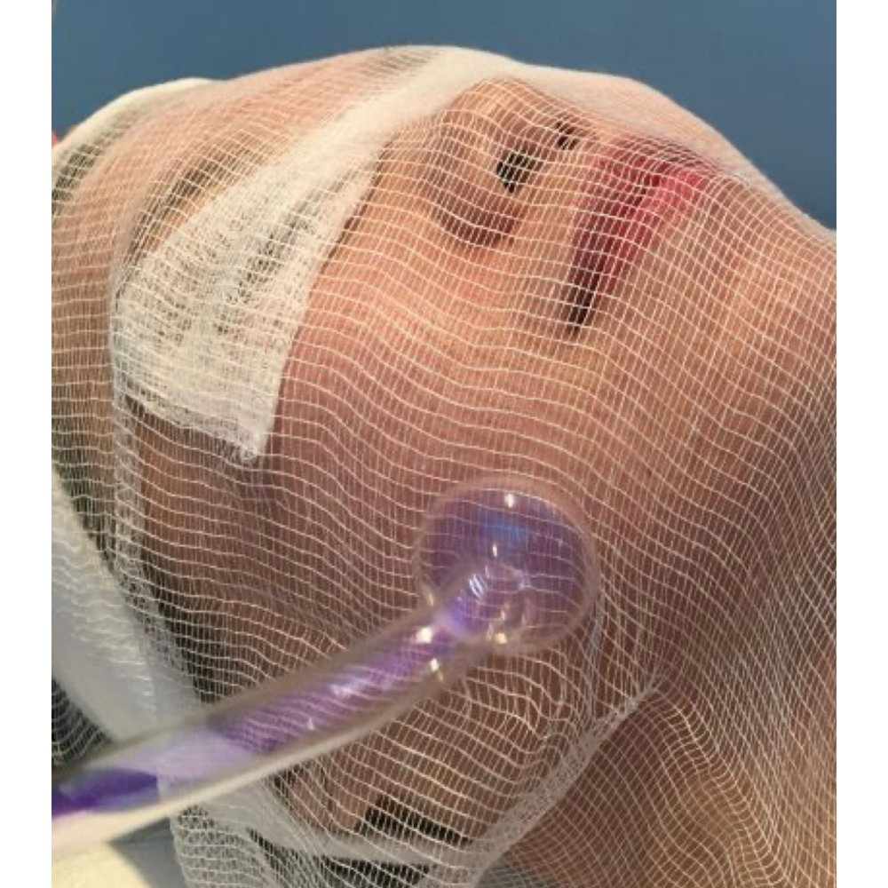 Skin Clarifying High Frequency at PureBeauty-Aesthetics in Colorado Springs, CO