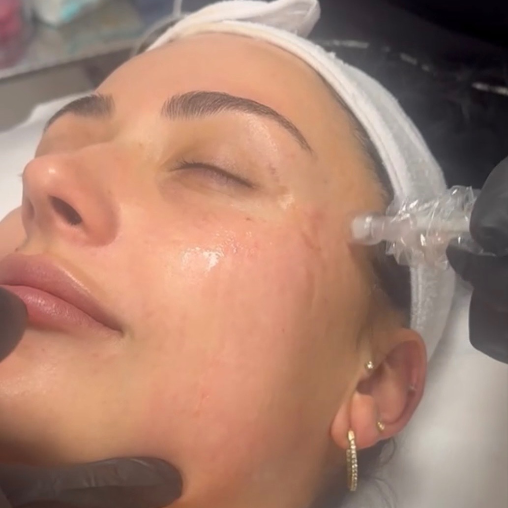 Timeless Skin Microneedling at Timeless Beauty by Bridget in Peoria, AZ