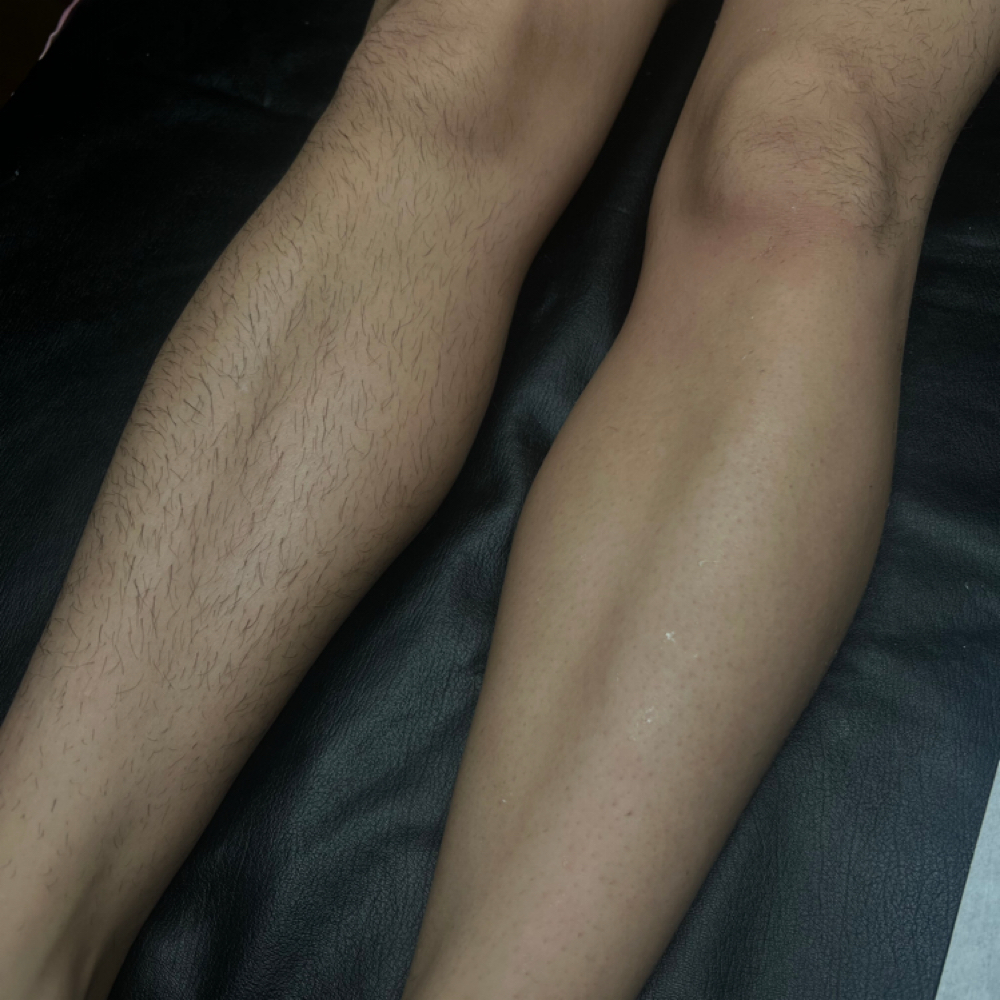 Half Leg at 5StarEsthetics in Minneapolis, MN