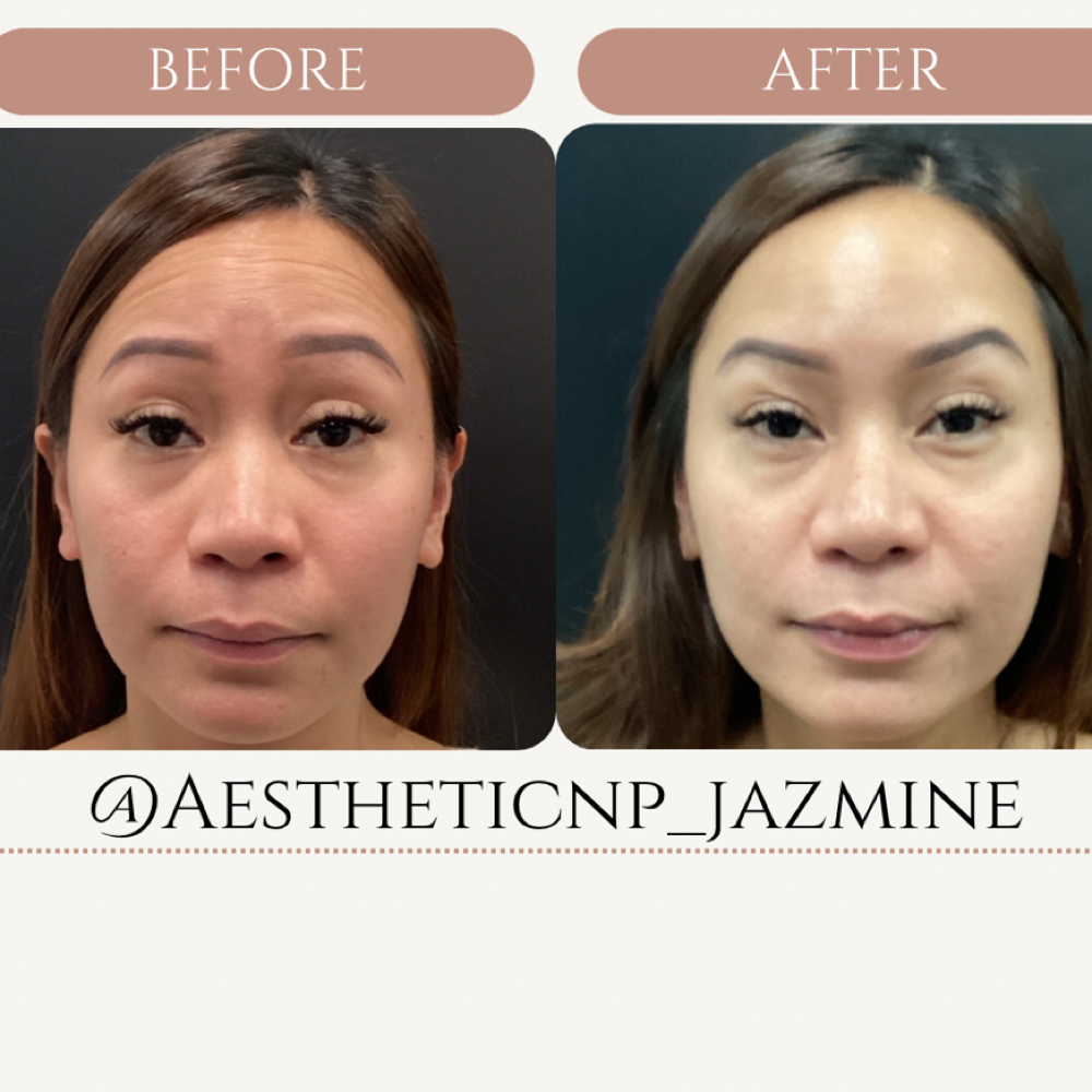 Forehead Neurotoxin at Amoris Aesthetic in Hillsborough, NJ